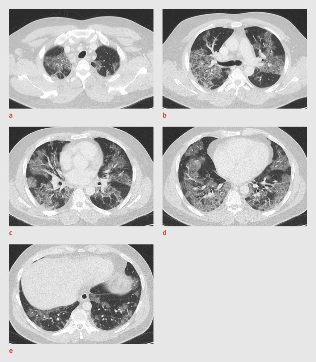 Figuur 2 | Afwijkingen op CT-scan bij COVID-19