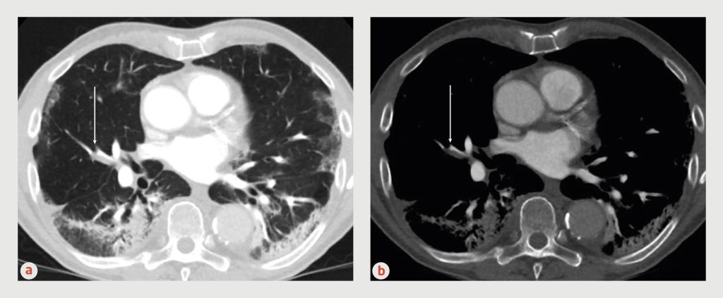 Figuur | Longembolie op CT-scan