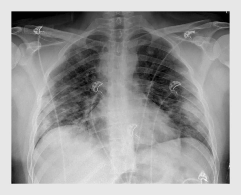 Figuur 1 | Thoraxfoto van patiënt B | Deze patiënt was na 2 weken met klachten passend bij covid-19 toenemend kortademig geworden