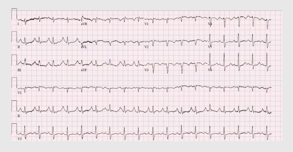 Figuur 2 | Ecg van patiënt C, die herstellende was van covid-19 maar plotseling fors benauwd was geworden