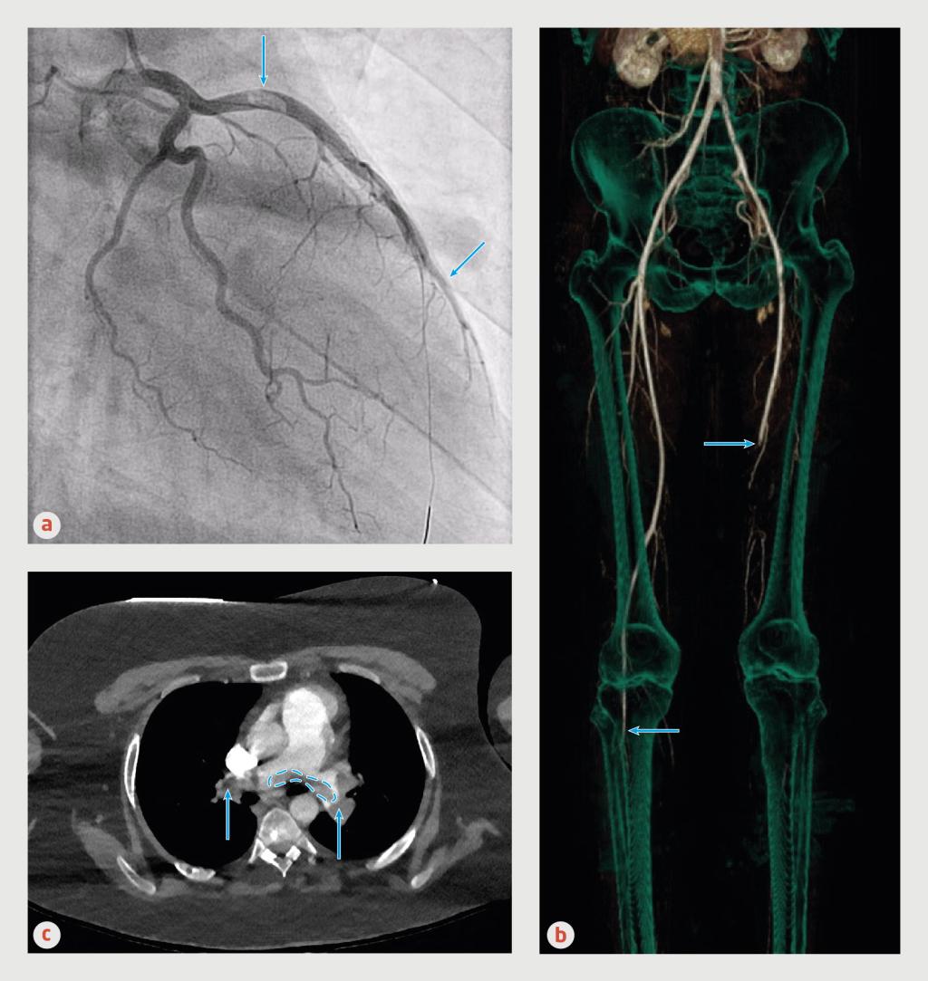 Figuur 2 | Trombo-embolieën van patiënt A, B en C