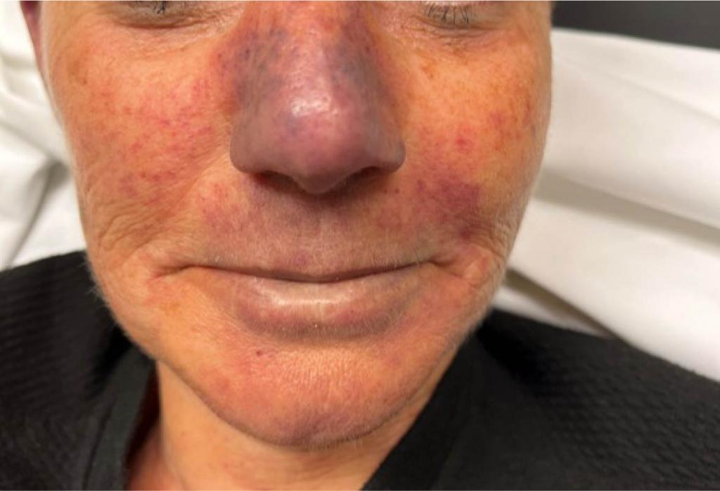 Vrouw met een paarsrode neus