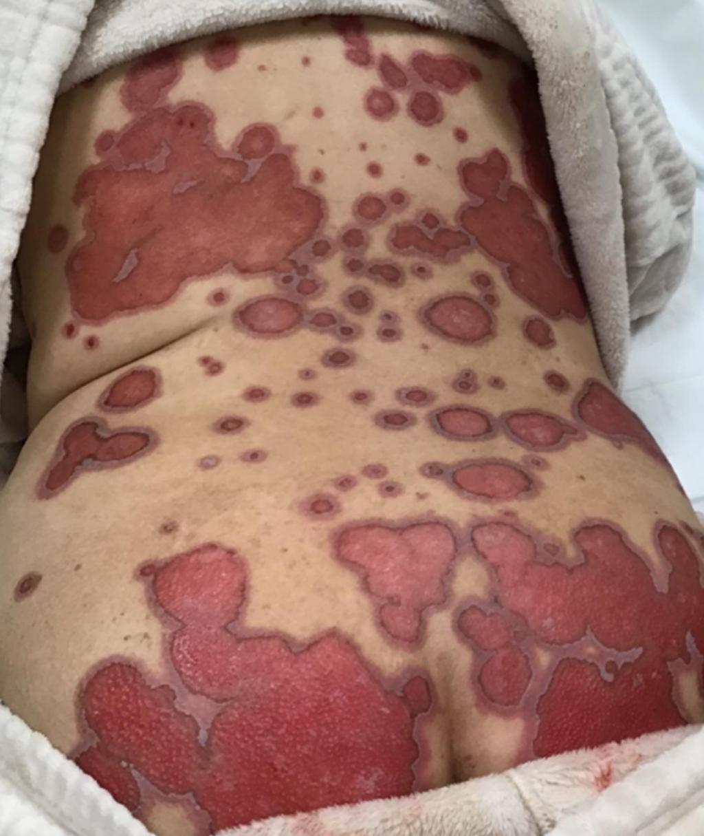 Huid met afwijkingen