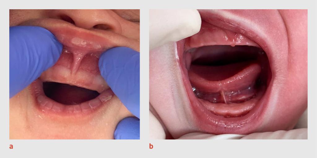 Figuur | Het frenulum van de bovenlip en tong