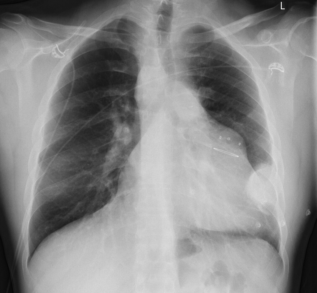 Röntgenbeeld van de borstkas